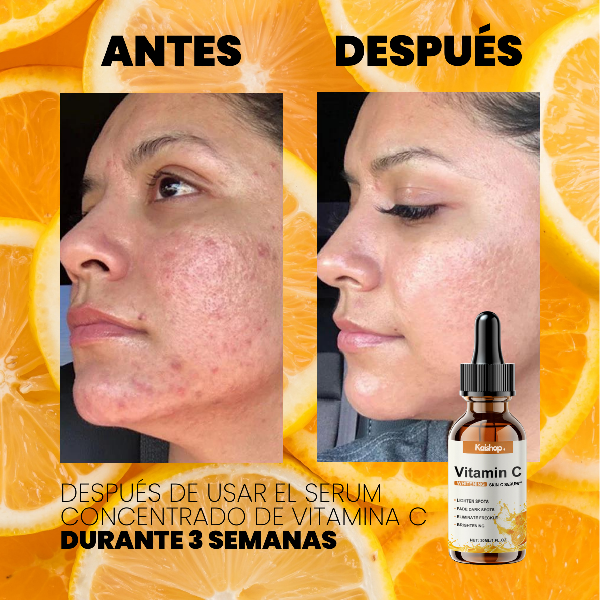 SERUM CONCENTRADO de VITAMINA C. COLÁGENO y ÁCIDO HIALURÓNICO - SKIN C SERUM™ (1 + 2 GRATIS)