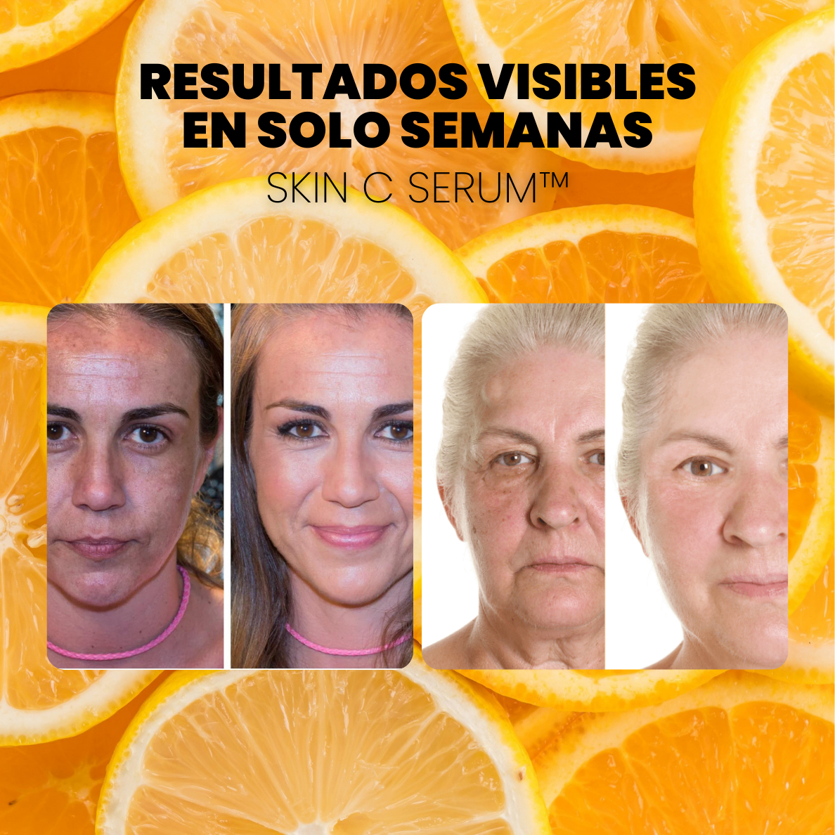 SERUM CONCENTRADO de VITAMINA C. COLÁGENO y ÁCIDO HIALURÓNICO - SKIN C SERUM™ (1 + 2 GRATIS)