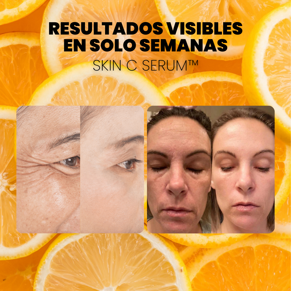 SERUM CONCENTRADO de VITAMINA C. COLÁGENO y ÁCIDO HIALURÓNICO - SKIN C SERUM™ (1 + 2 GRATIS)