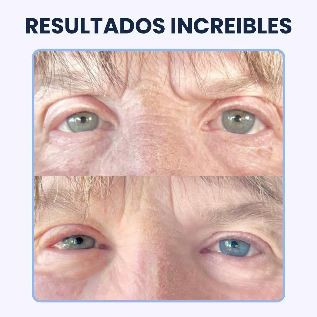 CREMA PARA OJERAS Y BOLSAS | 100% de efectividad | OpenEyes™ (1 + 1 GRATIS)