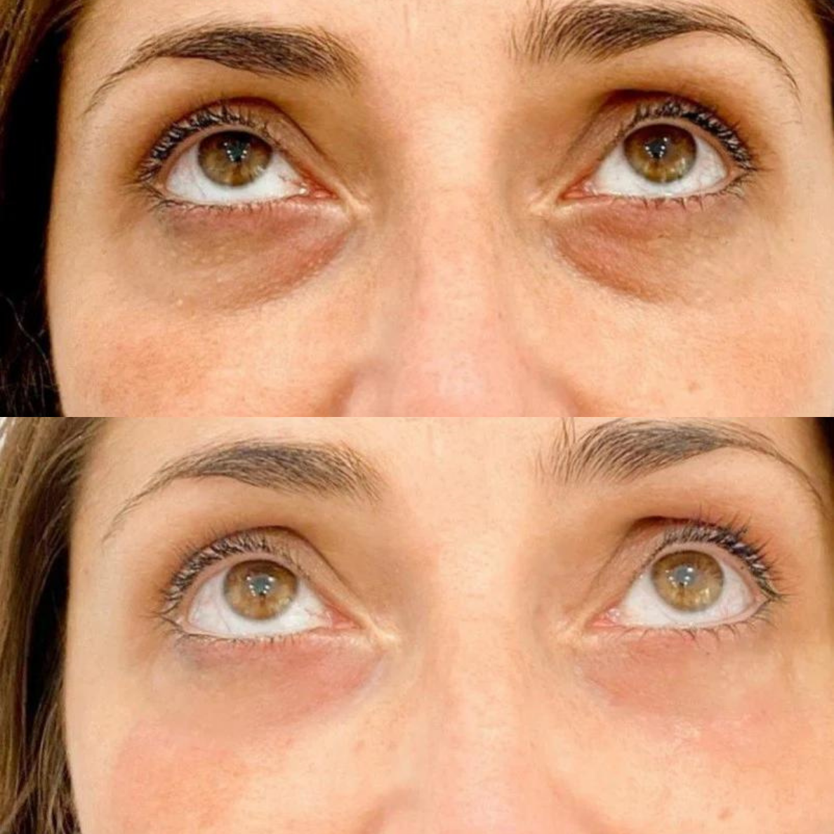 CREMA PARA OJERAS Y BOLSAS | 100% de efectividad | OpenEyes™ (1 + 1 GRATIS)