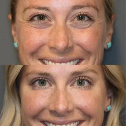 CREMA PARA OJERAS Y BOLSAS | 100% de efectividad | OpenEyes™ (1 + 1 GRATIS)